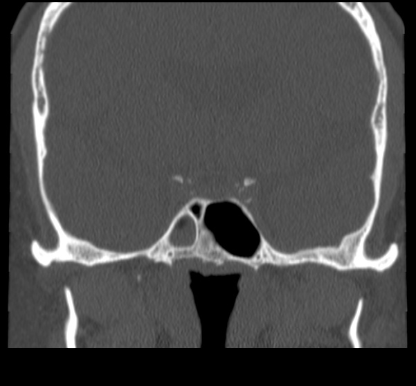 Acute sinusitis (Radiopaedia 23161-23215 Coronal bone window 52).jpg