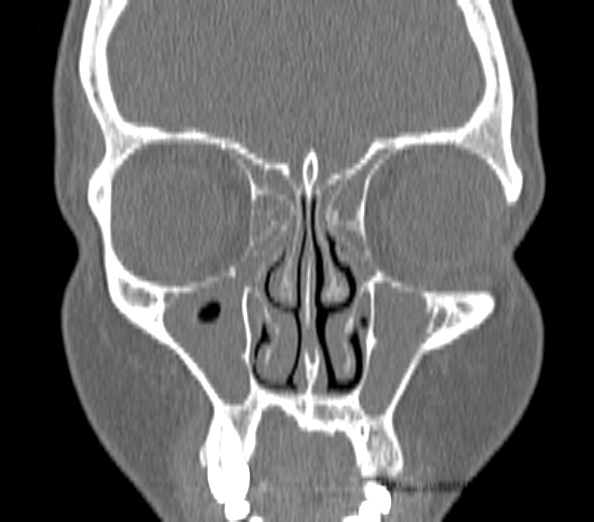 File:Acute sinusitis (Radiopaedia 40564-43158 Coronal bone window 12).jpg
