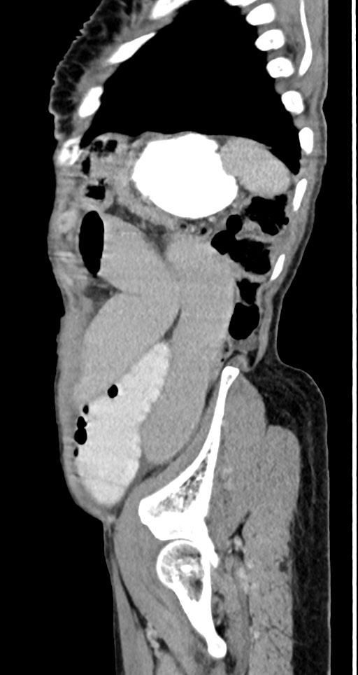Acute small bowel (ileal) volvulus (Radiopaedia 71740-82139 Sagittal C+ portal venous phase 40).jpg