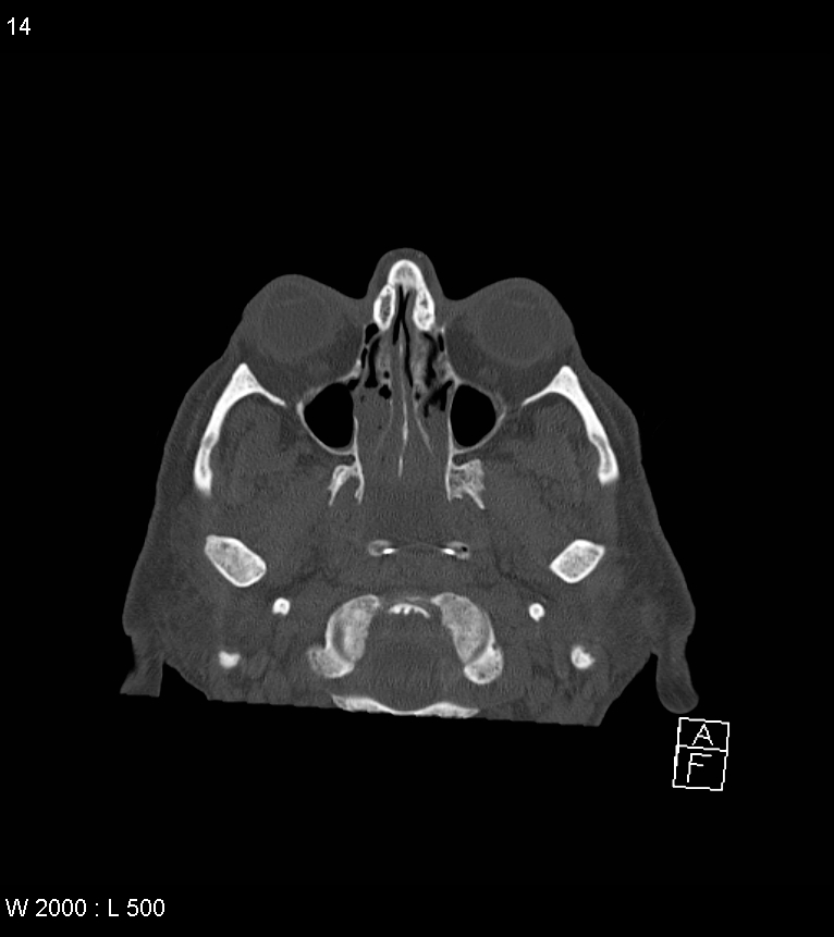 Acute subdural hematoma with myelofibrosis (Radiopaedia 52582-58494 Axial bone window 7).jpg