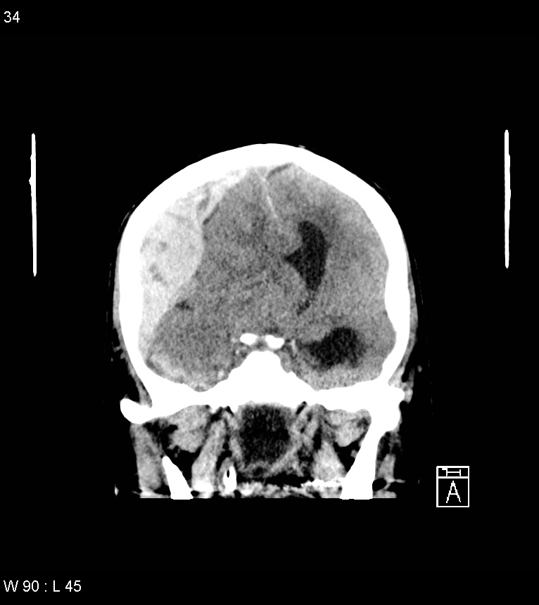 Acute subdural hematoma with myelofibrosis (Radiopaedia 52582-58494 Coronal non-contrast 25).jpg