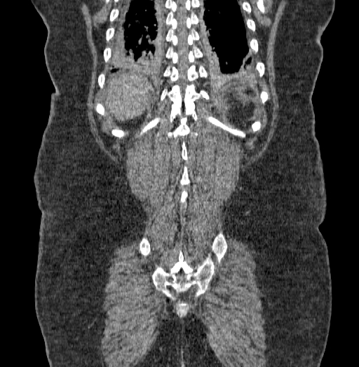 Acute superior mesenteric artery occlusion (Radiopaedia 51288-56960 Coronal C+ portal venous phase 65).jpg