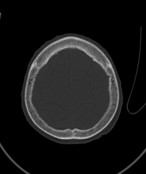 Acute traumatic subdural hematoma (Radiopaedia 82921-97257 Axial bone window 25).jpg