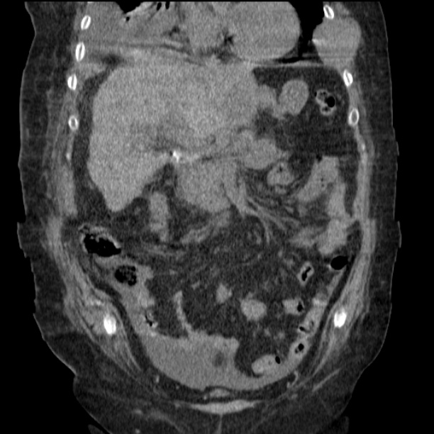 Acute tubular necrosis (Radiopaedia 28077-28334 D 36).jpg