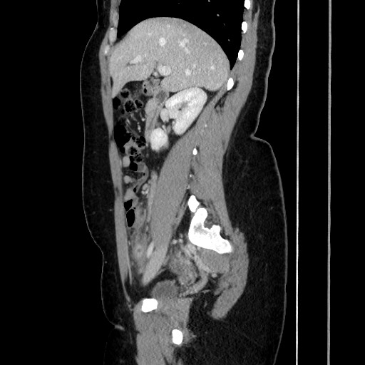 Acute uncomplicated appendicitis (Radiopaedia 73704-84499 Sagittal C+ portal venous phase 90).jpg