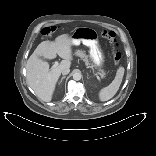 Adenocarcioma of rectum- T1 lesion (Radiopaedia 36921-38547 Axial C+ portal venous phase 24).png
