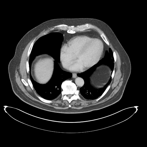 Adenocarcioma of rectum- T1 lesion (Radiopaedia 36921-38547 Axial C+ portal venous phase 8).png