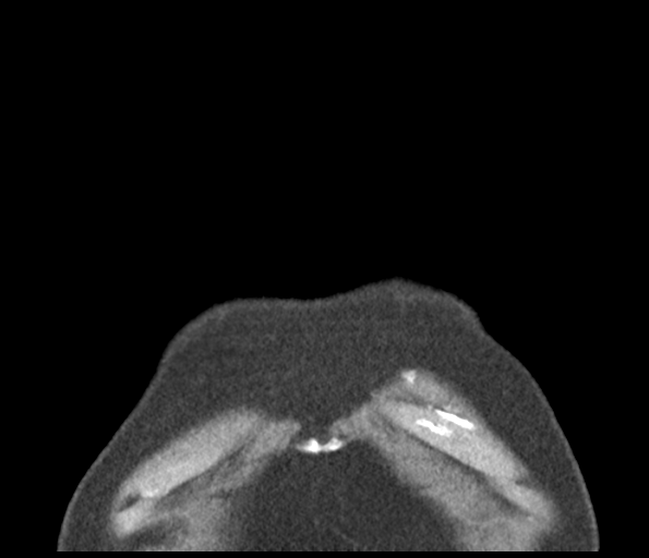 Adenocarcioma of rectum- T1 lesion (Radiopaedia 36921-38547 Coronal C+ arterial phase 5).png