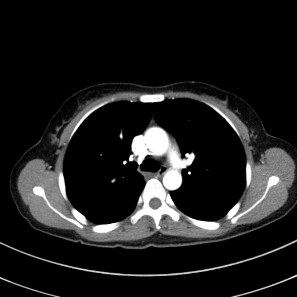 File:Adenocystic carcinoma of the trachea (Radiopaedia 47677-52525 Axial C+ arterial phase 45).jpg