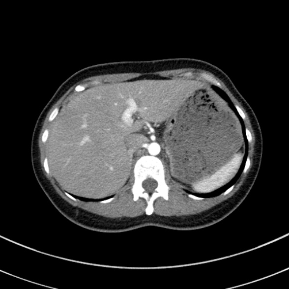 File:Adenocystic carcinoma of the trachea (Radiopaedia 47677-52525 Axial C+ arterial phase 77).jpg
