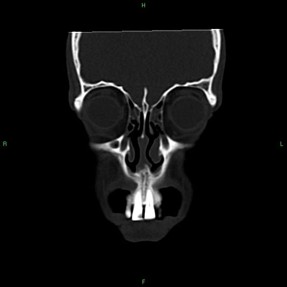 File:Adenoid cystic carcinoma of hard palate (Radiopaedia 26137-26273 Coronal bone window 4).jpg