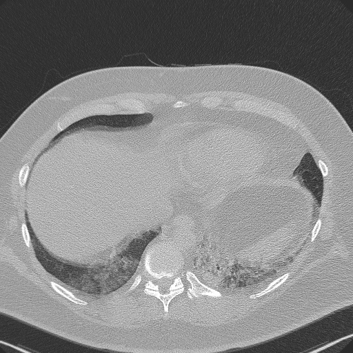 Adenoid cystic carcinoma of the trachea (Radiopaedia 49042-54137 Axial lung window 279).jpg