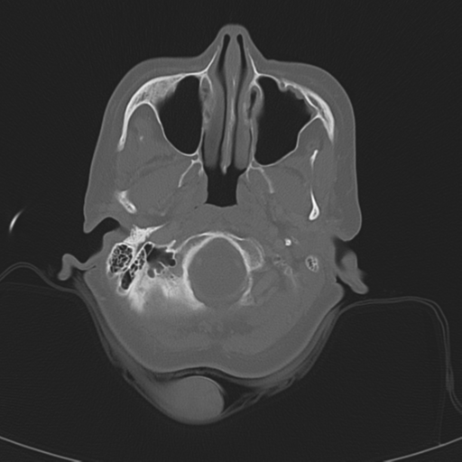 Adenoid cystic tumor of palate (Radiopaedia 46980-51518 Axial bone window 21).png