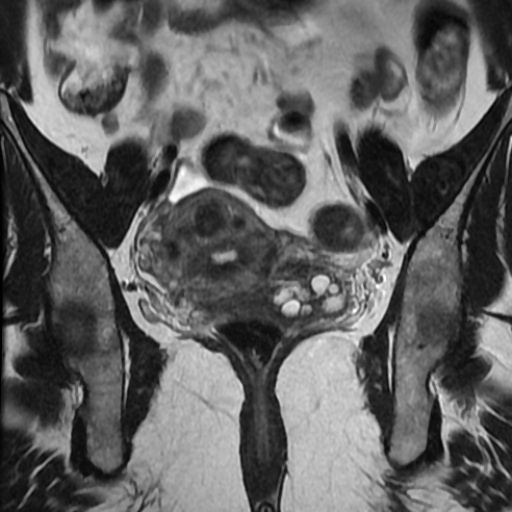 File:Adenoma malignum of cervix (Radiopaedia 66441-75705 Coronal T2 10).jpg