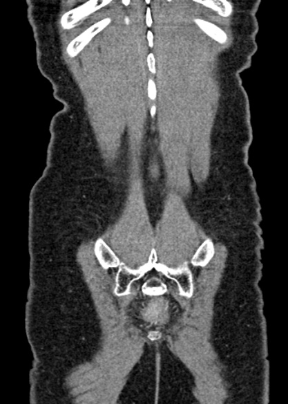 Adhesional small bowel obstruction (Radiopaedia 48397-53305 Coronal C+ portal venous phase 321).jpg