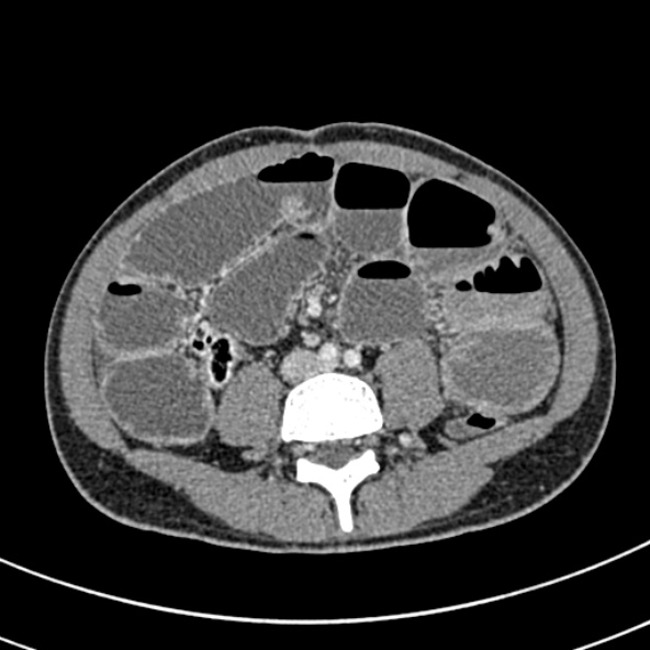 Adhesional small bowel obstruction (Radiopaedia 52107-57980 Axial C+ portal venous phase 75).jpg