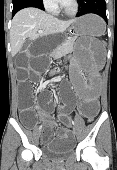 Adhesional small bowel obstruction (Radiopaedia 52107-57980 Coronal C+ portal venous phase 35).jpg