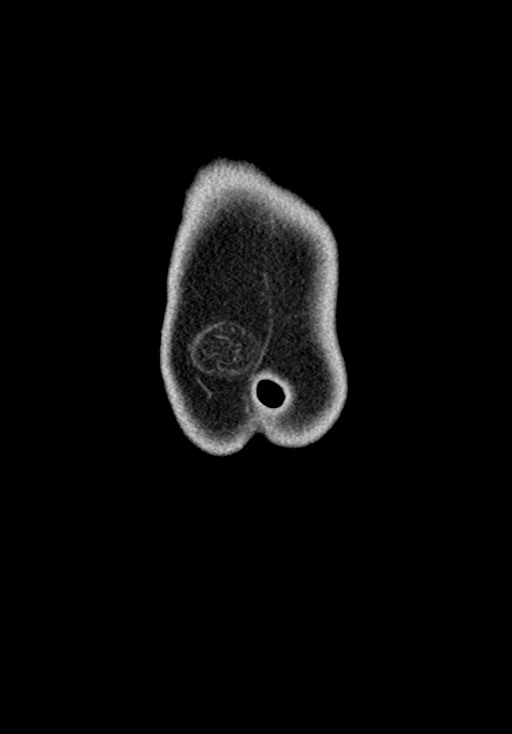 Adhesional small bowel obstruction (Radiopaedia 58900-66131 Coronal C+ portal venous phase 42).jpg