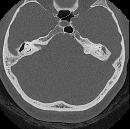 File:Adhesive chronic otitis media (Radiopaedia 14270-14148 Axial bone window 1).jpg