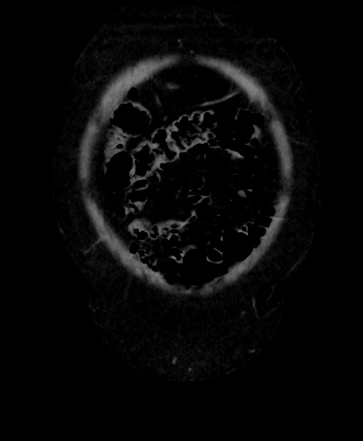 Adrenal cortical carcinoma (Radiopaedia 64017-72769 Coronal C+ delayed 10).jpg