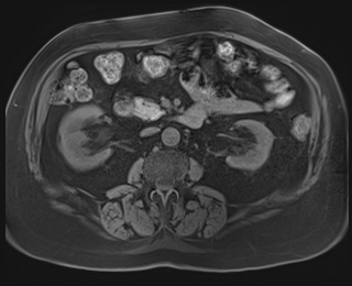 Adrenal cortical carcinoma (Radiopaedia 64017-72770 Axial T1 fat sat 47).jpg