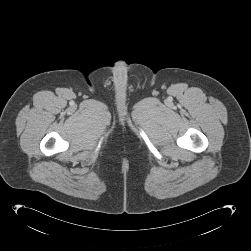 File:Adrenal cyst (Radiopaedia 45625-49776 Axial C+ portal venous phase 109).png
