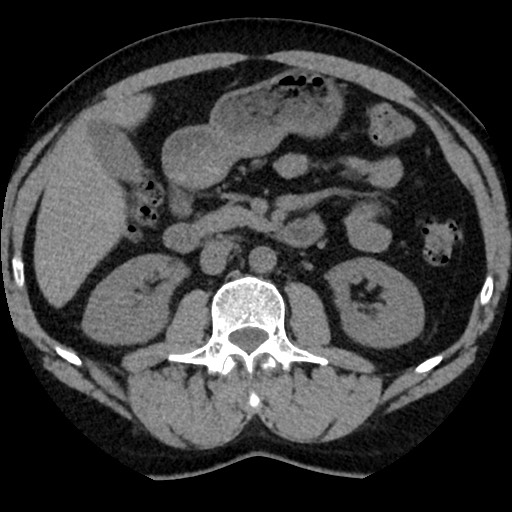 Adrenal gland trauma (Radiopaedia 81351-95079 Axial non-contrast 47).jpg