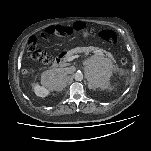 Adrenal lymphoma (Radiopaedia 84145-99415 Axial C+ portal venous phase 40).jpg