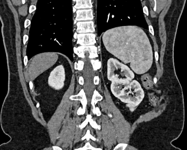 File:Adrenal metastases (Radiopaedia 73082-83791 Coronal C+ arterial phase 64).jpg