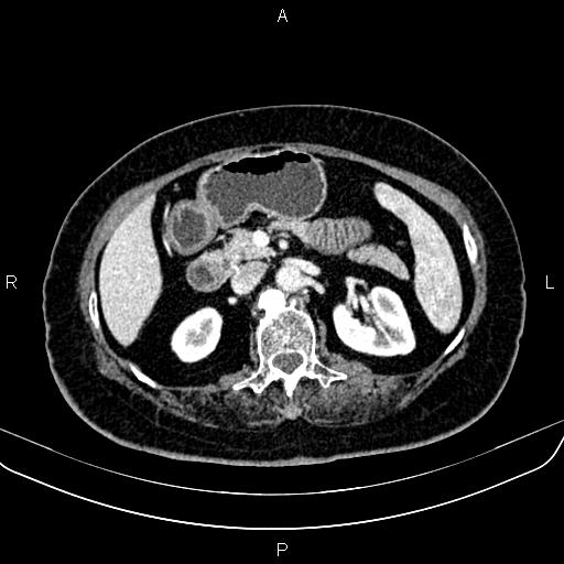 Adrenal myelolipoma (Radiopaedia 82742-96986 Axial renal cortical phase 66).jpg