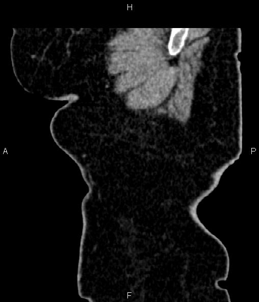 Adrenal myelolipoma (Radiopaedia 82742-96986 Sagittal renal cortical phase 10).jpg