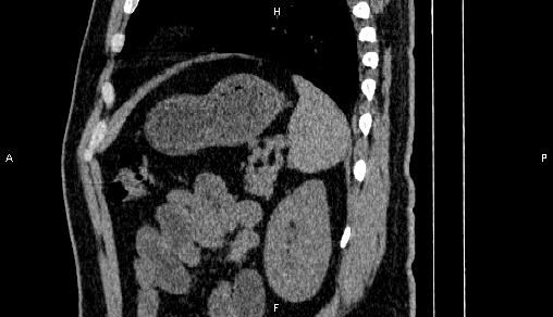 Adrenal myelolipoma (Radiopaedia 84321-99619 Sagittal non-contrast 84).jpg