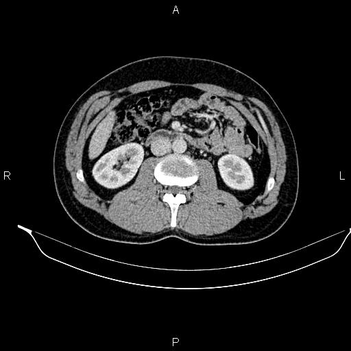 Adrenal myelolipoma (Radiopaedia 87794-104246 Axial renal cortical phase 51).jpg