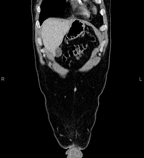 Adrenal myelolipoma (Radiopaedia 87794-104246 Coronal renal cortical phase 6).jpg