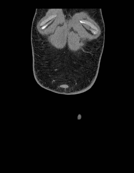 Adrenal myelolipoma - bilateral (Radiopaedia 74805-85810 Coronal C+ portal venous phase 255).jpg