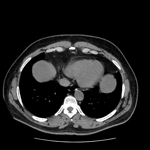Adrenal myelolipoma and beaver tail liver (Radiopaedia 86201-102193 Axial non-contrast 19).jpg