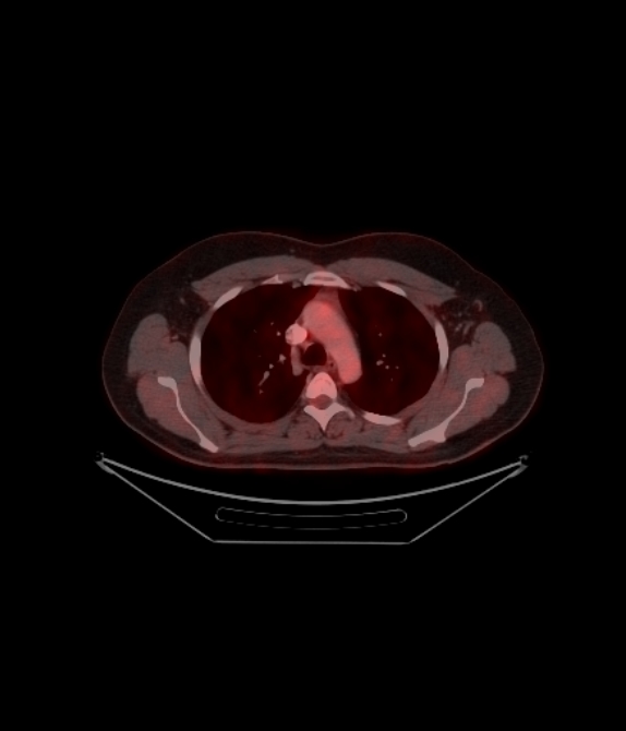 Adrenocortical carcinoma (Radiopaedia 80134-93440 ِAxial 103).jpg