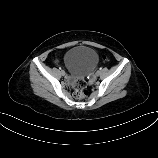 Adrenocortical carcinoma (Radiopaedia 87281-103569 Axial C+ portal venous phase 71).jpg
