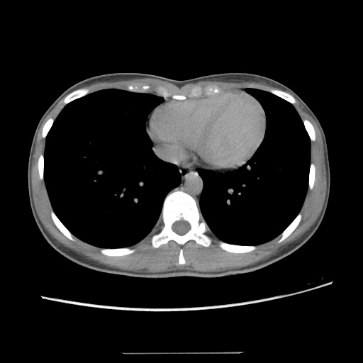 Adult polycystic kidney disease (Radiopaedia 48845-53876 Axial renal excretory phase 8).jpg