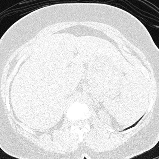 File:Air trapping in small airway disease (Radiopaedia 61685-69694 Axial lung window 201).jpg