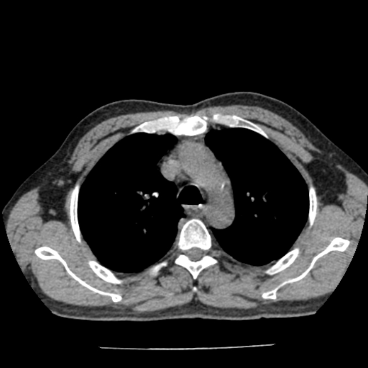 Airway foreign body in adult (Radiopaedia 85907-101779 Axial liver window 40).jpg