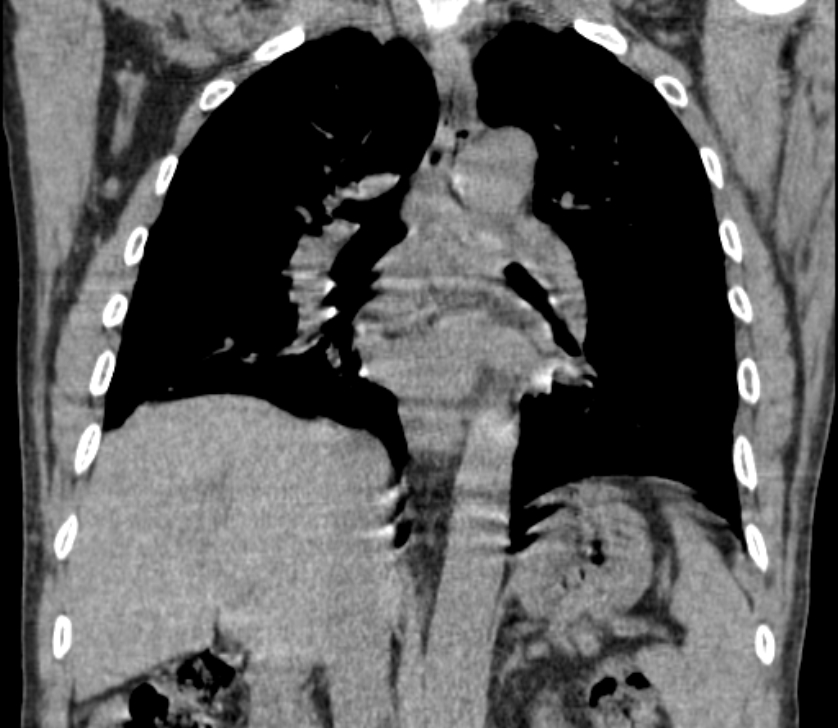 Airway foreign body in adult (Radiopaedia 85907-101779 Coronal liver window 158).jpg