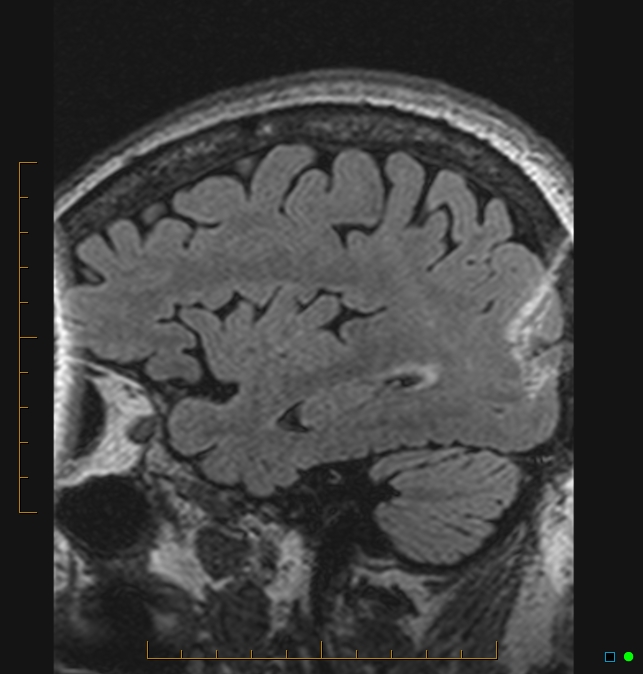 Aliasing artifact causing a spurious cerebellar lesion (Radiopaedia 48783-53810 Sagittal FLAIR 101).jpg