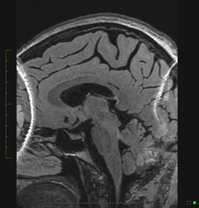 Aliasing artifact causing a spurious cerebellar lesion (Radiopaedia 48783-53810 Sagittal FLAIR 38).jpg