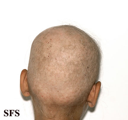 Alopecia Areata (Dermatology Atlas 52).jpg