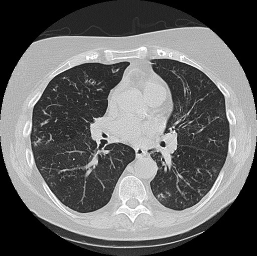 Alpha-1-antitrypsin deficiency (Radiopaedia 72058-82557 Axial lung window 39).jpg