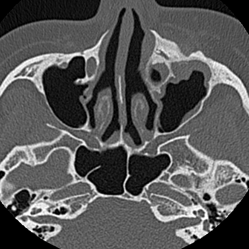 File:Ameloblastic fibro-odontoma (Radiopaedia 18843-18780 C 11).jpg