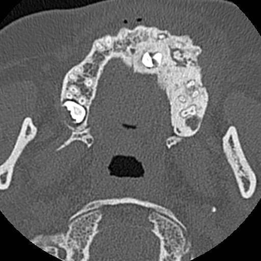 Ameloblastic fibro-odontoma (Radiopaedia 18843-18780 C 41).jpg