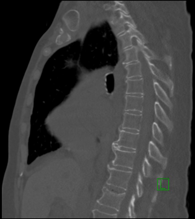 Amiodarone deposition in the liver (Radiopaedia 77587-89780 Sagittal bone window 56).jpg