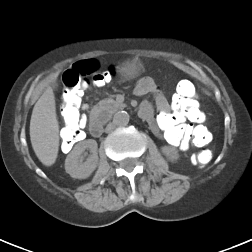 File:Ampullary adenocarcinoma (Radiopaedia 34013-35237 Axial non-contrast 25).png